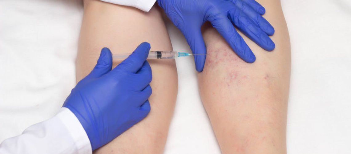 escleroterapia escleroterapia