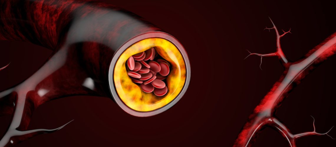3d Illustration of blood cells with plaque buildup of cholesterol aterosclerose
