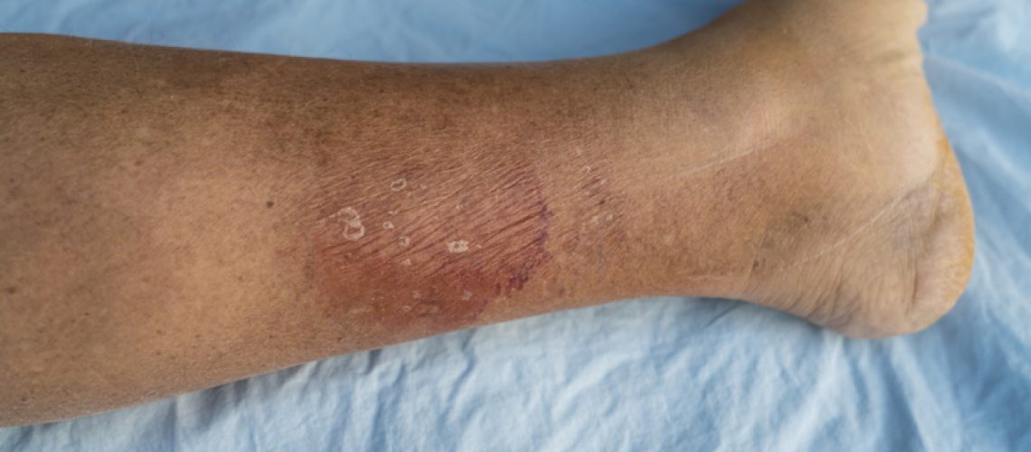 Erysipelas Bacterial infection, gout leg Erysipelas bacterial infection Under the skin leg, on blue bedding.
