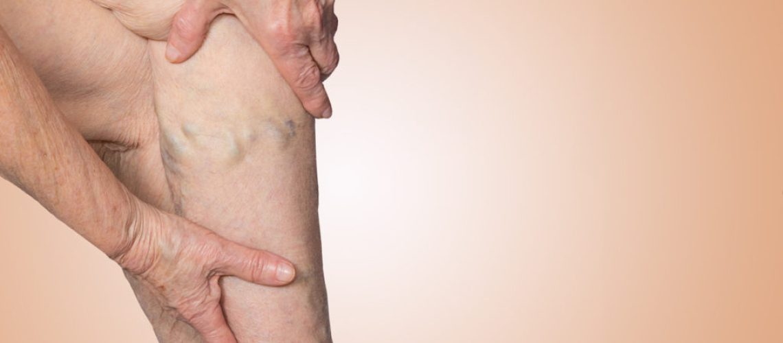 The varicose veins on a legs of old woman on pastel trombose