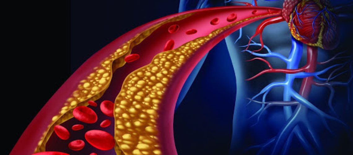 unnamed arteriosclerose